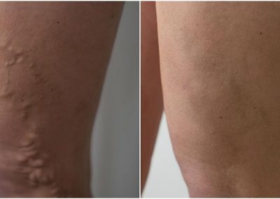 varicose-veins-treatment-evla-laser-removal-procedure-before-after-photos-the-private-clinic